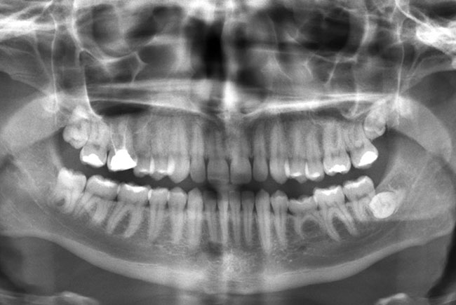 máy chụp x-quang răng là gì?